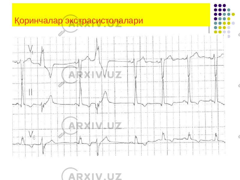 Қоринчалар экстрасистолалари 