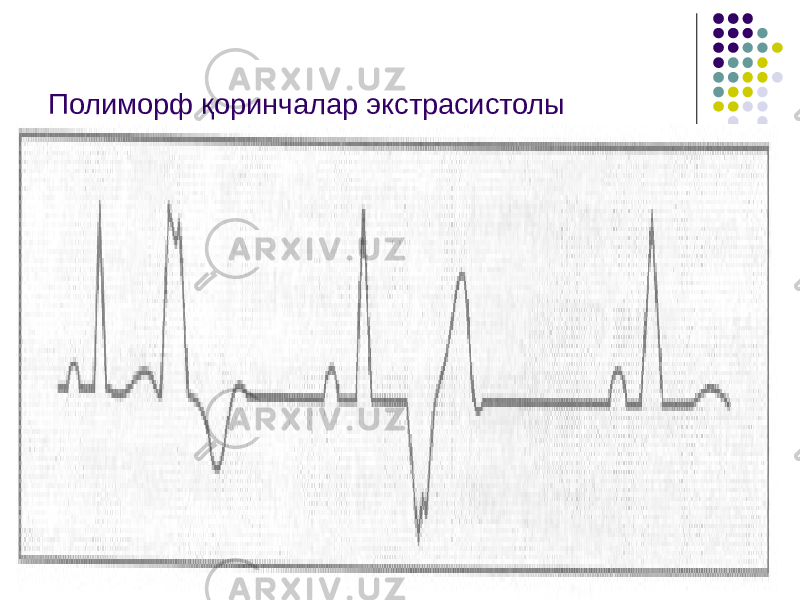 Полиморф қоринчалар экстрасистолы 