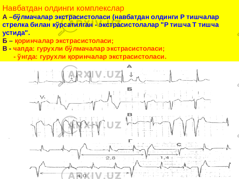 Навбатдан олдинги комплекслар А – бўлмачалар экстрасистоласи (навбатдан олдинги Р тишчалар стрелка билан кўрсатилган - экстрасистолалар &#34;Р тишча Т тишча устида&#34;. Б – қоринчалар экстрасистоласи; В - чапда: гурухли бўлмачалар экстрасистоласи; - ўнгда: гурухли қоринчалар экстрасистоласи. 