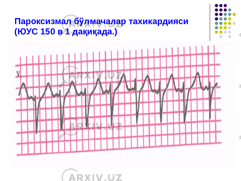 Пароксизмал бўлмачалар тахикардияси (ЮУС 150 в 1 дақиқада.) 