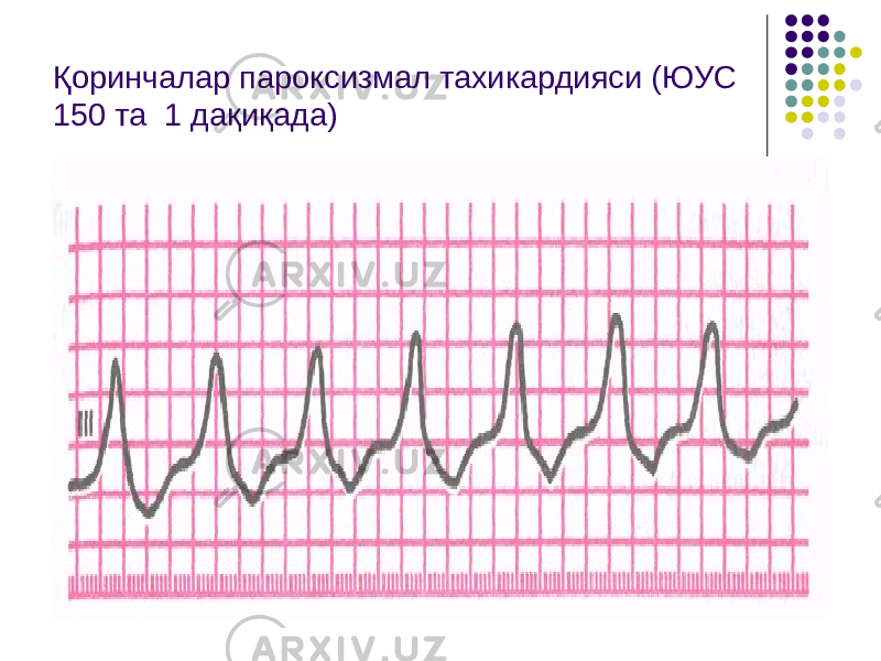 Қоринчалар пароксизмал тахикардияси (ЮУС 150 та 1 дақиқада) 