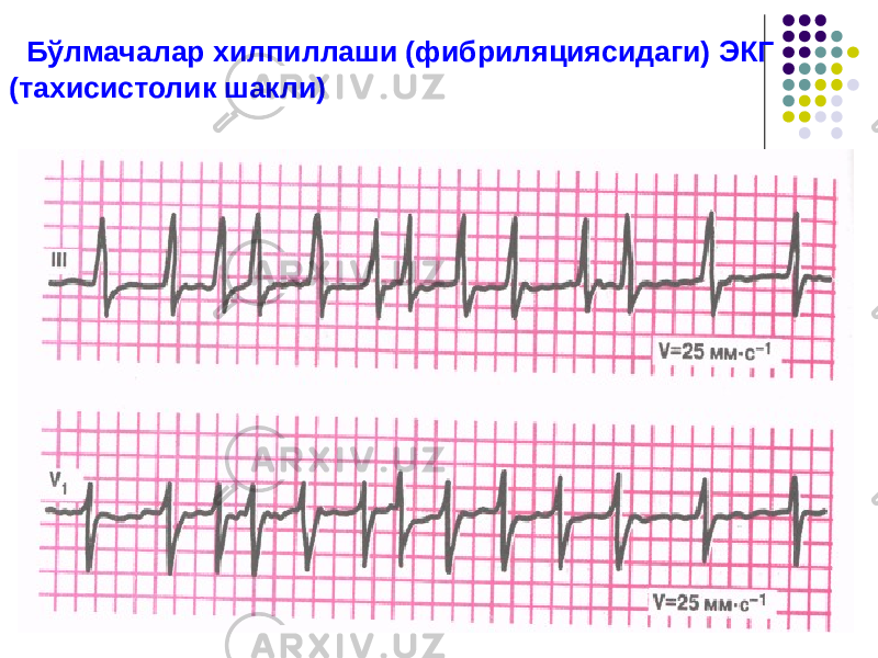  Бўлмачалар хилпиллаши (фибриляциясидаги) ЭКГ (тахисистолик шакли) 