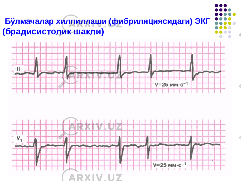  Бўлмачалар хилпиллаши (фибриляциясидаги) ЭКГ (брадисистолик шакли) 