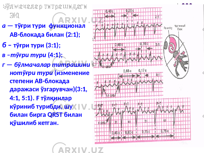 Бўлмачалар титрашидаги ЭКГ а — тўғри тури функционал АВ-блокада билан (2:1); б – тўғри тури (3:1); в –тўғри тури (4:1); г — бўлмачалар титрашини нотўғри тури (изменение степени АВ-блокада даражаси ўзгарувчан)(3:1, 4:1, 5:1). F тўлқинлар кўриниб турибди, шу билан бирга QRST билан қўшилиб кетган. 