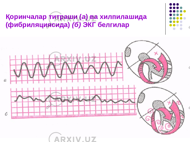 Қоринчалар титраши ( а ) ва хилпилашида (фибриляциясида) (б) ЭКГ белгилар 
