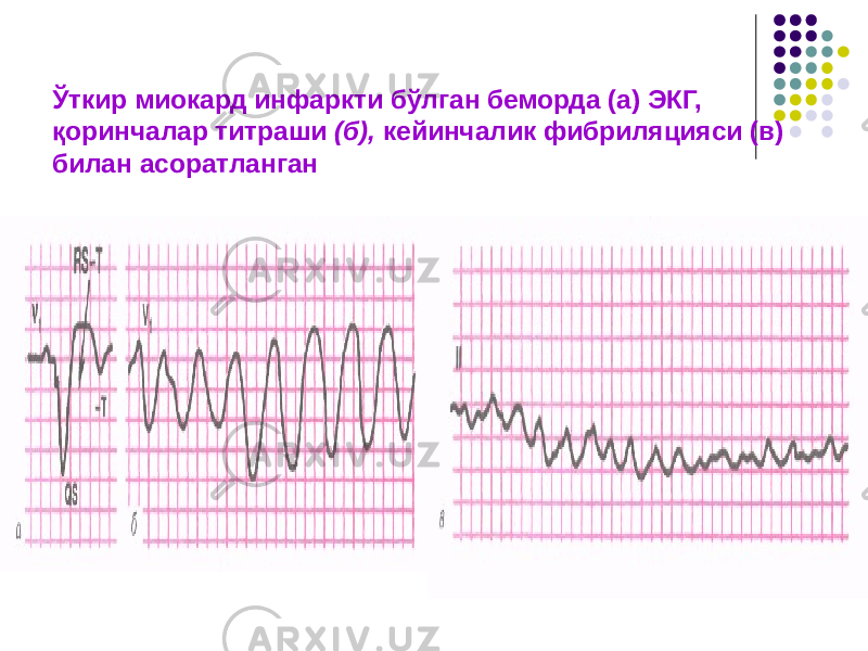 Ўткир миокард инфаркти бўлган беморда (а) ЭКГ, қоринчалар титраши (б), кейинчалик фибриляцияси (в) билан асоратланган 