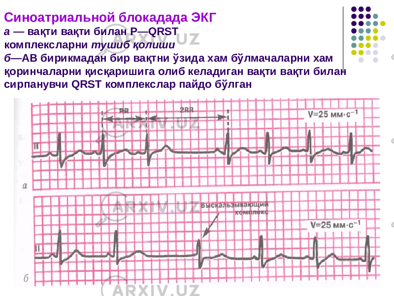 Синоатриальной блокадада ЭКГ а — вақти вақти билан Р—QRST комплексларни тушиб қолиши б —АВ бирикмадан бир вақтни ўзида хам бўлмачаларни хам қоринчаларни қисқаришига олиб келадиган вақти вақти билан сирпанувчи QRST комплекслар пайдо бўлган 