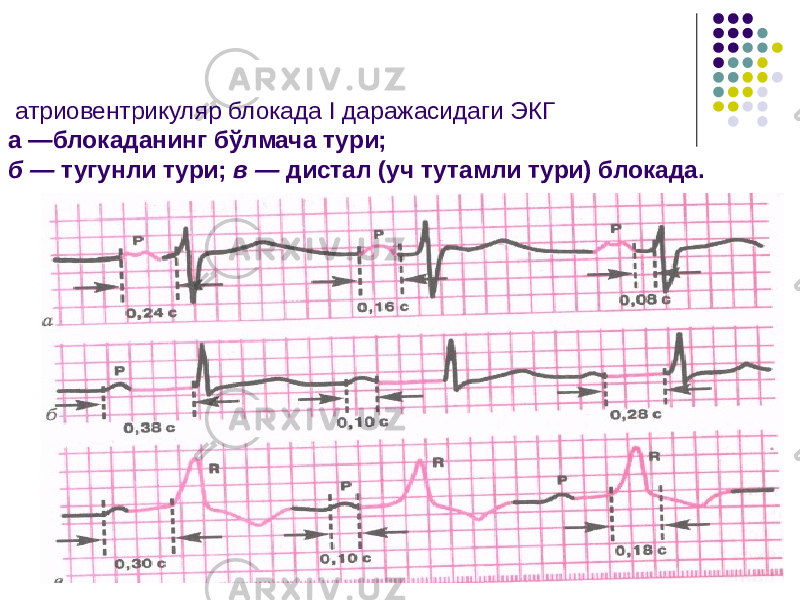  атриовентрикуляр блокада I даражасидаги ЭКГ а —блокаданинг бўлмача тури; б — тугунли тури; в — дистал (уч тутамли тури) блокада. 