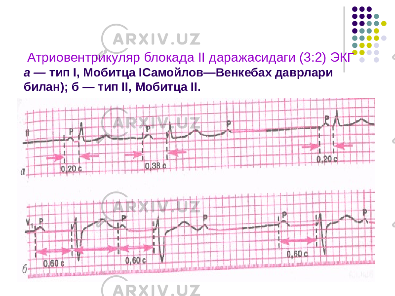  Атриовентрикуляр блокада II даражасидаги (3:2) ЭКГ а — тип I, Мобитца IСамойлов—Венкебах даврлари билан); б — тип II, Мобитца II. 