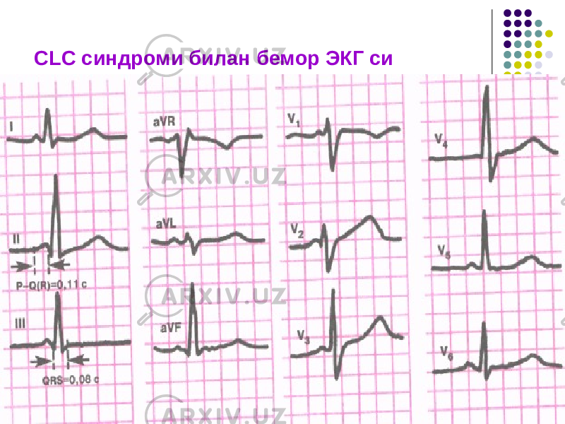 CLC синдроми билан бемор ЭКГ си 