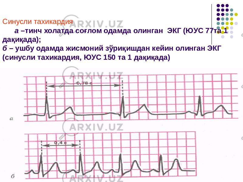 Синусли тахикардия а –тинч холатда соғлом одамда олинган ЭКГ (ЮУС 77та 1 дақиқада); б – ушбу одамда жисмоний зўриқишдан кейин олинган ЭКГ (синусли тахикардия, ЮУС 150 та 1 дақиқада) 