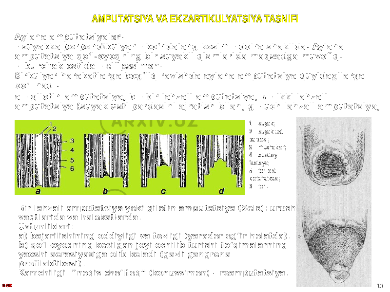 AMPUTATSIYA VA EKZARTIKULYATSIYA TASNIFI Aylana amputatsiyalar: – suyakka perpendikulyar – koʻndalang kesim – doira shaklida. Aylana amputatsiya qoʻl-oyoqning bir suyakli qismlarida maqsadga muvofiq. – burchak ostida – ellipssimon. Sirkulyar harakatlarga bogʻliq ravishda aylana amputatsiya quyidagilarga boʻlinadi: а – gilotin amputatsiya; b – bir lahzali amputatsiya; в – ikki lahzali amputatsiya (suyak usti pardasini ajratish bilan; g – uch lahzali amputatsiya; © GID 101 – suyak; 2 – suyak usti pardasi; 3 – mushaklar; 4 – xususiy fastsiya; 5 – teri osti kletchatkasi; 6 – teri. Bir lahzali amputatsiya yoki gilotin amputatsiya (Sels): urush vaqtlarida va halokatlarda. Ustunliklari: a) bajarilishining oddiyligi va tezligi (yarador ogʻir holatda). b) qoʻl-oyoqning kesilgan joyi ochilib turishi toʻqimalarning yaxshi aerasiyasiga olib keladi (gazli gangrena profilaktikasi). Kamchiligi: “noqis choʻltoq” (konussimon) – reamputatsiya. 