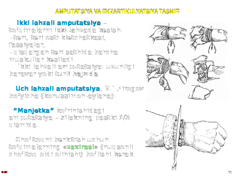 AMPUTATSIYA VA EKZARTIKULYATSIYA TASNIFI Ikki lahzali amputatsiya – toʻqimalarni ikki lahzada kesish: - teri, teri osti kletchatkasi, fassiyalar; - qisqargan teri sathida barcha muskullar kesiladi. Ikki lahzali amputatsiya: uzunligi baravar yoki turli hajmda Uch lahzali amputatsiya , N.I.Pirogov boʻyicha (konussimon-aylana). “ Manjetka” koʻrinishidagi amputatsiya – bilakning pastki 1/3 qismida. Choʻltoqni berkitish uchun toʻqimalarning « zaxirasi » (nuqsonli choʻltoq oldi olinishi) boʻlishi kerak. © GID 11 