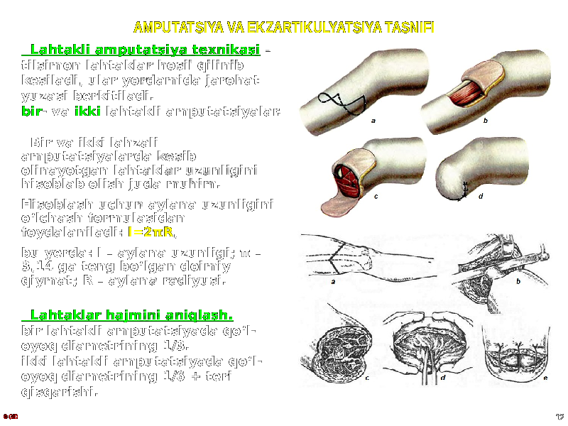 AMPUTATSIYA VA EKZARTIKULYATSIYA TASNIFI Lahtakli amputatsiya texnikasi – tilsimon lahtaklar hosil qilinib kesiladi, ular yordamida jarohat yuzasi berkitiladi. bir - va ikki lahtakli amputatsiyalar. Bir va ikki lahzali amputatsiyalarda kesib olinayotgan lahtaklar uzunligini hisoblab olish juda muhim. Hisoblash uchun aylana uzunligini oʻlchash formulasidan foydalaniladi: l=2πR , bu yerda: l – aylana uzunligi; π – 3,14 ga teng boʻlgan doimiy qiymat; R – aylana radiyusi. Lahtaklar hajmini aniqlash. bir lahtakli amputatsiyada qoʻl- oyoq diametrining 1/3. ikki lahtakli amputatsiyada qoʻl- oyoq diametrining 1/6 + teri qisqarishi. © GID 12 