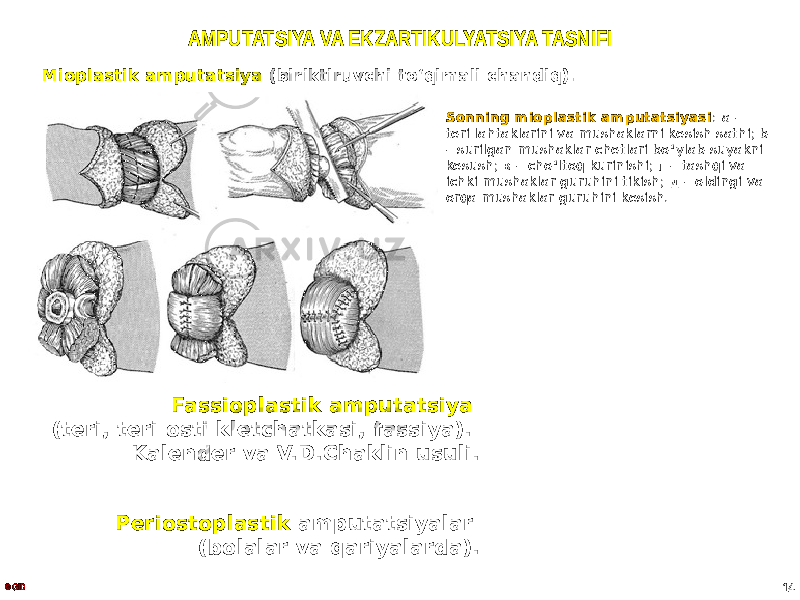 AMPUTATSIYA VA EKZARTIKULYATSIYA TASNIFI Mioplastik amputatsiya (biriktiruvchi toʻqimali chandiq). © GID 14Sonning mioplastik amputatsiyasi : а – teri lahtaklarini va mushaklarni kesish sathi; b – surilgan mushaklar chetlari bo ʻ ylab suyakni kesush; в – cho ʻ ltoq kurinishi; г – tashqi va ichki mushaklar guruhini tikish; д – oldingi va orqa mushaklar guruhini kesish. Fassioplastik amputatsiya (teri, teri osti kletchatkasi, fassiya). Kalender va V.D.Chaklin usuli. Periostoplastik amputatsiyalar (bolalar va qariyalarda). 