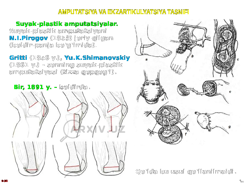 AMPUTATSIYA VA EKZARTIKULYATSIYA TASNIFI Suyak-plastik amputatsiyalar. Suyak-plastik amputatsiyani N.I.Pirogov (1853) joriy qilgan (boldir-panja boʻgʻimida) . Gritti (1856 y.), Yu.K.Shimanovskiy (1861 y.) – sonning suyak-plastik amputatsiyasi (tizza qopqogʻi). Bir, 1891 y. – boldirda. © GID 15Qoʻlda bu usul qoʻllanilmaidi. 