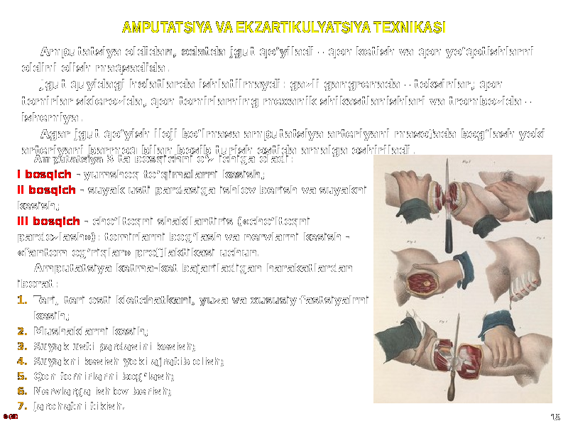 AMPUTATSIYA VA EKZARTIKULYATSIYA TEXNIKASI Amputatsiya oldidan, odatda jgut qoʻyiladi – qon ketish va qon yoʻqotishlarni oldini olish maqsadida. Jgut quyidagi holatlarda ishlatilmaydi: gazli gangrenada – toksinlar; qon tomirlar sklerozida, qon tomirlarning mexanik shikastlanishlari va trombozida – ishemiya. Agar jgut qoʻyish iloji boʻlmasa amputatsiya arteriyani masofada bogʻlash yoki arteriyani barmoq bilan bosib turish ostida amalga oshiriladi. © GID 18Amputatsiya 3 ta bosqichni oʻz ichiga oladi: I bosqich - yumshoq toʻqimalarni kesish; II bosqich - suyak usti pardasiga ishlov berish va suyakni kesish; III bosqich - choʻltoqni shakllantiris («choʻltoqni pardozlash»): tomirlarni bogʻlash va nervlarni kesish - «fantom ogʻriqlar» profilaktikasi uchun. Amputatsiya ketma-ket bajariladigan harakatlardan iborat: 1. Teri, teri osti kletchatkani, yuza va xususiy fastsiyalrni kesih; 2. Mushaklarni kesih; 3. Suyak usti pardasini kesish; 4. Suyakni kesish yoki ajratib olish; 5. Qon tomirlarni bog ʻ lash; 6. Nervlarga ishlov berish; 7. Jarohatni tikish. 