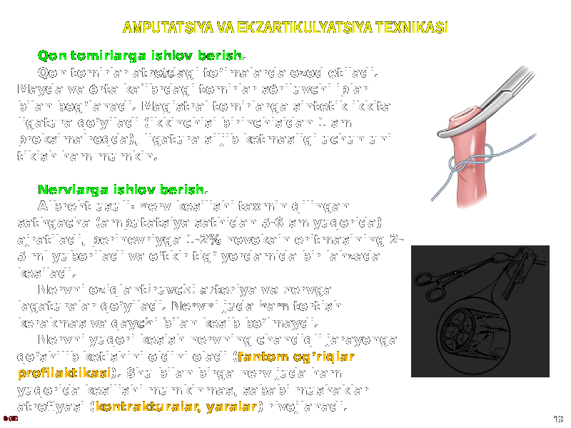 AMPUTATSIYA VA EKZARTIKULYATSIYA TEXNIKASI Qon tomirlarga ishlov berish . Qon tomirlar atrofdagi to ̒ʻimalarda ozod etiladi. Mayda va o̒rta kalibrdagi tomirlar so ̒riluvchi iplar bilan bogʻlanadi. Magistral tomirlarga sintetik ikkita ligatura qoʻyiladi (ikkinchisi birinchisidan 1 sm proksimalroqda), ligatura siljib ketmasligi uchun uni tikish ham mumkin. Nervlarga ishlov berish . Albreht usuli: nerv kesilishi taxmin qilingan sathgacha (amputatsiya sathidan 5-6 sm yuqorida) ajratiladi, perinevriyga 1-2% novokain eritmasining 2- 5 ml yuboriladi va oʻtkir tigʻ yordamida bir lahzada kesiladi. Nervni oziqlantiruvchi arteriya va nervga lagaturalar qoʻyiladi. Nervni juda ham tortish kerakmas va qaychi bilan kesib boʻlmaydi. Nervni yuqori kesish nervning chandiqli jarayonga qoʻshilib ketishini oldini oladi ( fantom ogʻriqlar profilaktikasi ). Shu bilan birga nerv juda ham yuqorida kesilishi mumkinmas, sababi mushaklar atrofiyasi ( kontrakturalar, yaralar ) rivojlanadi. © GID 19 