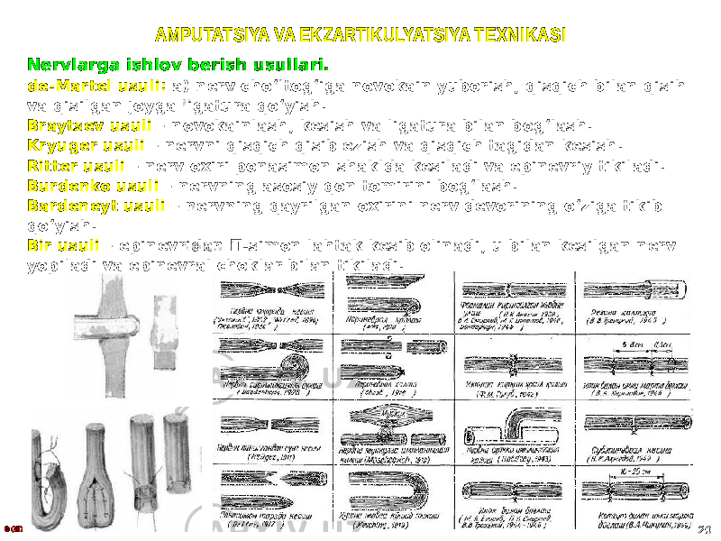 AMPUTATSIYA VA EKZARTIKULYATSIYA TEXNIKASI Nervlarga ishlov berish usullari. de-Martel usuli: а) nerv choʻltogʻiga novokain yuborish, qisqich bilan qisih va qisilgan joyga ligatura qoʻyish. Braytsev usuli – novokainlash, kesish va ligatura bilan bogʻlash. Kryuger usuli – nervni qisqich qisib ezish va qisqich tagidan kesish. Ritter usuli – nerv oxiri ponasimon shaklda kesiladi va epinevriy tikiladi. Burdenko usuli – nervning asosiy qon tomirini bogʻlash. Bardeneyt usuli – nervning qayrilgan oxirini nerv devorining oʻziga tikib qoʻyish. Bir usuli – epinevridan П-simon lahtak kesib olinadi, u bilan kesilgan nerv yopiladi va epinevral choklar bilan tikiladi. © GID 20 