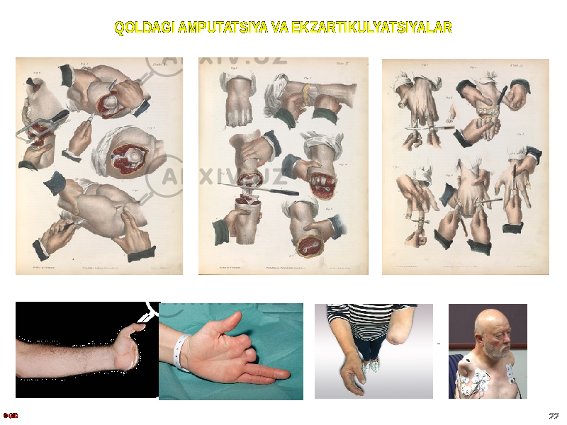 QOLDAGI AMPUTATSIYA VA EKZARTIKULYATSIYALAR . © GID 22 