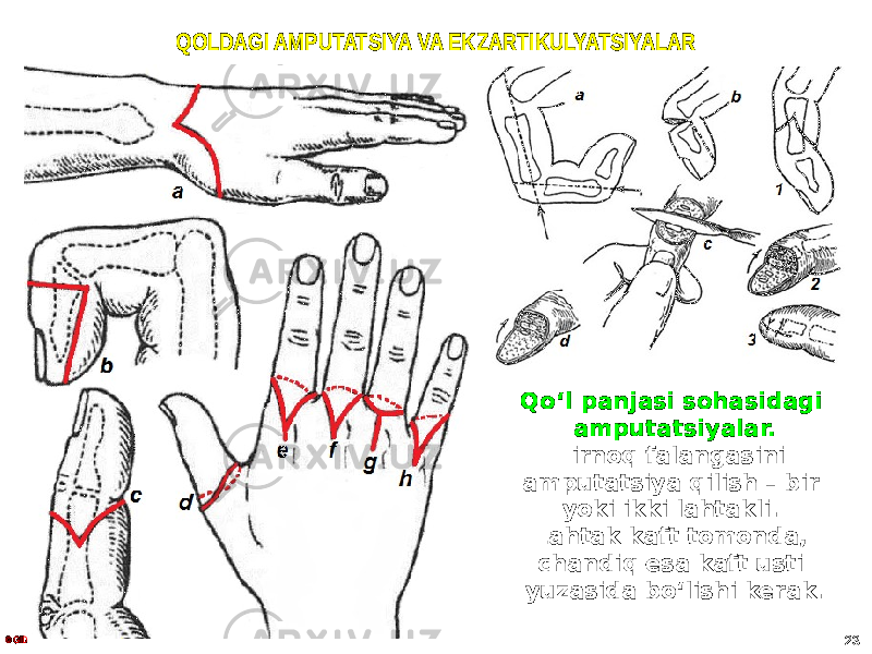 QOLDAGI AMPUTATSIYA VA EKZARTIKULYATSIYALAR Qoʻl panjasi sohasidagi amputatsiyalar. Tirnoq falangasini amputatsiya qilish – bir yoki ikki lahtakli. Lahtak kaft tomonda, chandiq esa kaft usti yuzasida bo ʻlishi kerak. © GID 23 