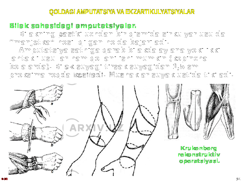 QOLDAGI AMPUTATSIYA VA EKZARTIKULYATSIYALAR Bilak sohasidagi amputatsiyalar. Bilakning pastki uchdan bir qismida sirkulyar usulda “manjetka” hosil qilgan holda bajariladi. Amputatsiya sathiga qarab bilakda aylana yoki ikki lahtakli usullar ham qollanilishi mumkin (kopincha bolalarda). Bilak suyagi tirsak suyagidan 1,5 sm proksimalroqda kesiladi. Mushaklar suyak ustida tikiladi. © GID 24Krukenberg rekonstruktiv operatsiyasi. 