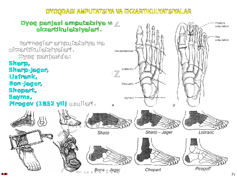 OYOQDAGI AMPUTATSIYA VA EKZARTIKULYATSIYALAR Oyoq panjasi amputatsiya va ekzartikulatsiyalari. Barmoqlar amputatsiya va ekzartikulatsiyalari. Oyoq panjasida: Sharp, Sharp-Jager, Lisfrank, Bon-Jager, Shopart, Sayms, Pirogov (1852 yil) usullari. © GID 27 