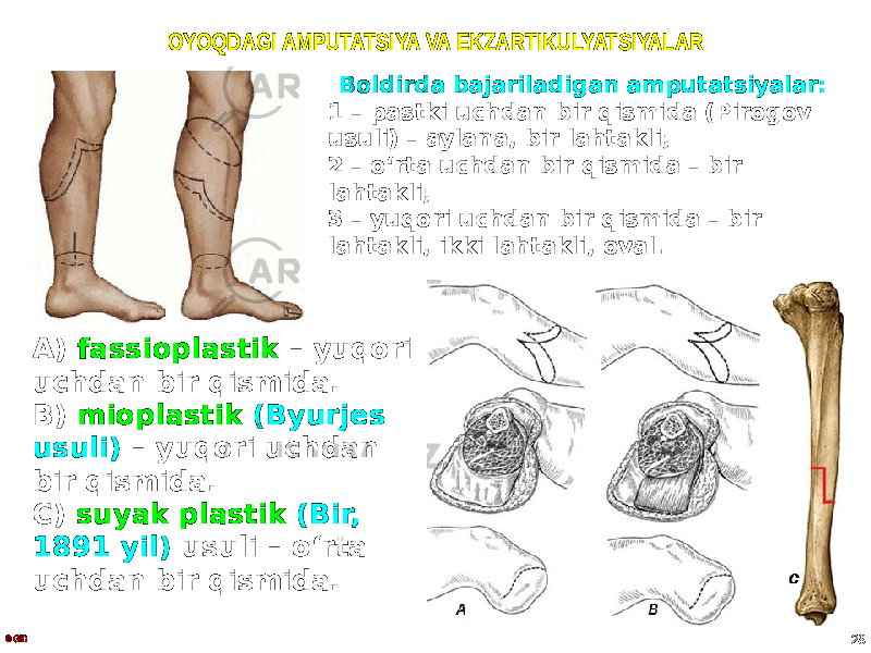 OYOQDAGI AMPUTATSIYA VA EKZARTIKULYATSIYALAR Boldirda bajariladigan amputatsiyalar: 1 – pastki uchdan bir qismida (Pirogov usuli) – aylana, bir lahtakli; 2 – o ʻrta uchdan bir qismida – bir lahtakli; 3 – yuqori uchdan bir qismida – bir lahtakli, ikki lahtakli, oval. © GID 28A) fassioplastik – yuqori uchdan bir qismida. B) mioplastik (Byurjes usuli) – yuqori uchdan bir qismida. C) suyak plastik (Bir, 1891 yil) usuli – o ʻrta uchdan bir qismida. 