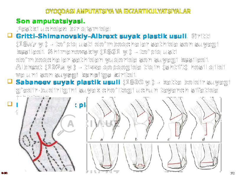 OYOQDAGI AMPUTATSIYA VA EKZARTIKULYATSIYALAR Son amputatsiyasi. Pastki uchdan bir qismida:  Gritti–Shimanovskiy–Albrext suyak plastik usuli . Gritti (1857 y.) – to ʻ piq usti do ʻ mboqchalar sathida son suyagi kesiladi. Shimanovskiy (1861 y.) – to ʻ piq usti do ʻ mboqchalar sathidan yuqorida son suyagi kesiladi. Albrext (1925 y.) – tizza qopqogida tiqin (shtift) hosil qildi va uni son suyagi kanaliga kiritdi.  Sabaneev suyak plastik usuli (1890 y.) – katta boldir suyagi g ʻ adir-budirligini suyak cho ʻ ltogi uchun tayanch sifatida ishlatgan.  Djanelidze suyak plastik usuli – kesib olingan suyakdan foydalangan. © GID 29 