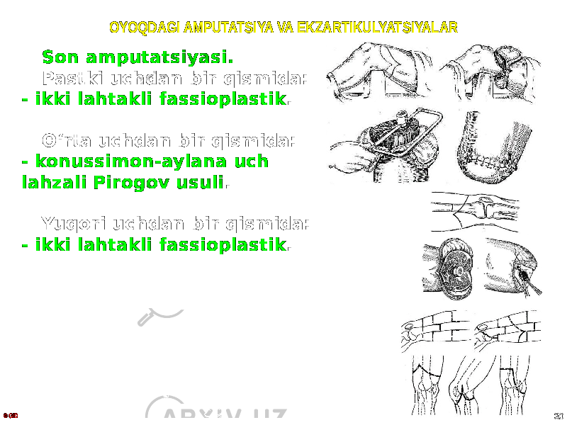 OYOQDAGI AMPUTATSIYA VA EKZARTIKULYATSIYALAR Son amputatsiyasi. Pastki uchdan bir qismida: - ikki lahtakli fassioplastik . O ʻrta uchdan bir qismida: - konussimon-aylana uch lahzali Pirogov usuli . Yuqori uchdan bir qismida: - ikki lahtakli fassioplastik . © GID 30 