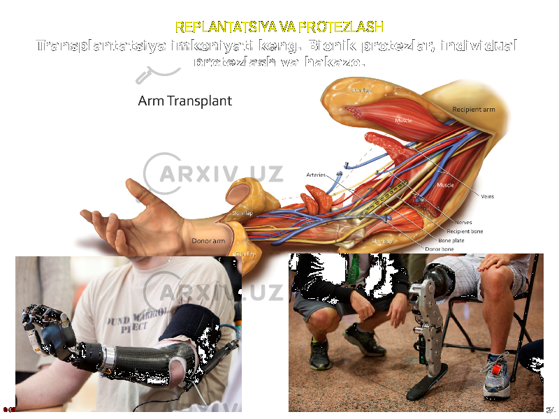 REPLANTATSIYA VA PROTEZLASH © GID 34Transplantatsiya imkoniyati keng. Bionik protezlar, individual protezlash va hakazo. 