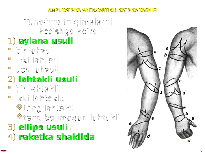 AMPUTATSIYA VA EKZARTIKULYATSIYA TASNIFI Yumshoq toʻqimalarni kesishga koʻra: 1) aylana usuli  bir lahzali  ikki lahzali  uch lahzali 2) lahtakli usuli  bir lahtakli  ikki lahtakli:  teng lahtakli  teng boʻlmagan lahtakli 3) ellips usuli . 4) raketka shaklida . © GID 9 