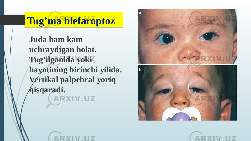 Tug’ma blefaroptoz Juda ham kam uchraydigan holat. Tug’ilganida yoki hayotining birinchi yilida. Vertikal palpebral yoriq qisqaradi. 