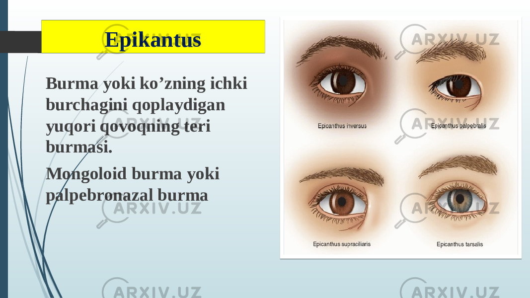 Epikantus Burma yoki ko’zning ichki burchagini qoplaydigan yuqori qovoqning teri burmasi. Mongoloid burma yoki palpebronazal burma 