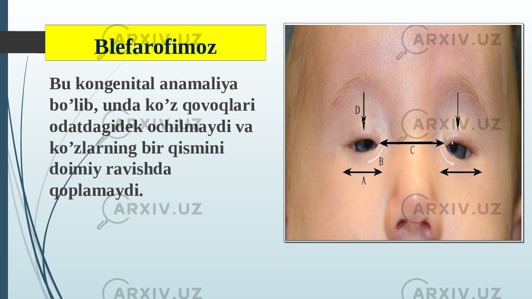 Blefarofimoz Bu kongenital anamaliya bo’lib, unda ko’z qovoqlari odatdagidek ochilmaydi va ko’zlarning bir qismini doimiy ravishda qoplamaydi. 