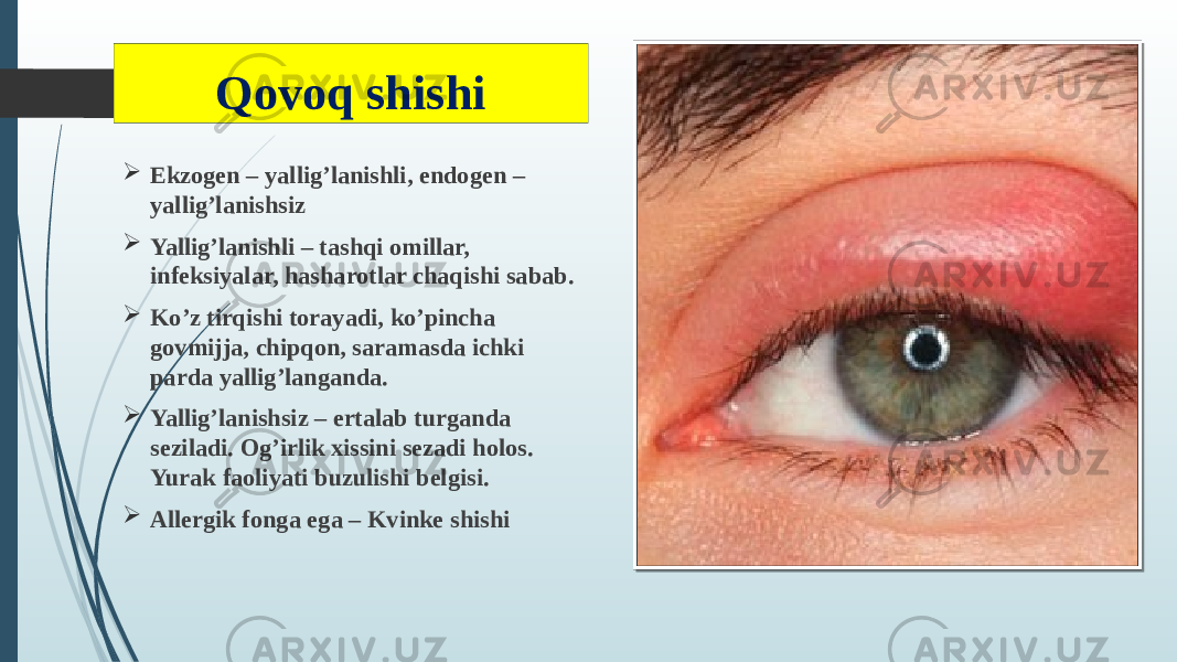 Qovoq shishi  Ekzogen – yallig’lanishli, endogen – yallig’lanishsiz  Yallig’lanishli – tashqi omillar, infeksiyalar, hasharotlar chaqishi sabab.  Ko’z tirqishi torayadi, ko’pincha govmijja, chipqon, saramasda ichki parda yallig’langanda.  Yallig’lanishsiz – ertalab turganda seziladi. Og’irlik xissini sezadi holos. Yurak faoliyati buzulishi belgisi.  Allergik fonga ega – Kvinke shishi 