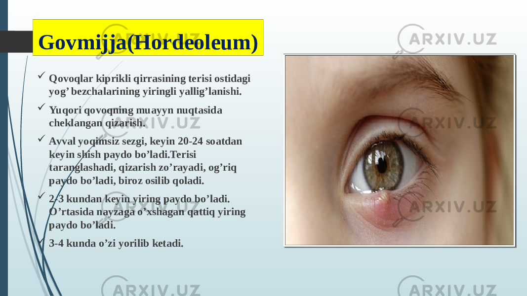 Govmijja(Hordeoleum)  Qovoqlar kiprikli qirrasining terisi ostidagi yog’ bezchalarining yiringli yallig’lanishi.  Yuqori qovoqning muayyn nuqtasida cheklangan qizarish.  Avval yoqimsiz sezgi, keyin 20-24 soatdan keyin shish paydo bo’ladi.Terisi taranglashadi, qizarish zo’rayadi, og’riq paydo bo’ladi, biroz osilib qoladi.  2-3 kundan keyin yiring paydo bo’ladi. O’rtasida nayzaga o’xshagan qattiq yiring paydo bo’ladi.  3-4 kunda o’zi yorilib ketadi. 