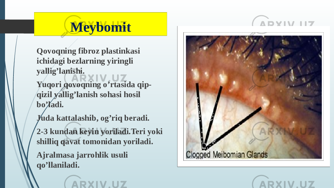 Meybomit Qovoqning fibroz plastinkasi ichidagi bezlarning yiringli yallig’lanishi. Yuqori qovoqning o’rtasida qip- qizil yallig’lanish sohasi hosil bo’ladi. Juda kattalashib, og’riq beradi. 2-3 kundan keyin yoriladi.Teri yoki shilliq qavat tomonidan yoriladi. Ajralmasa jarrohlik usuli qo’llaniladi. 