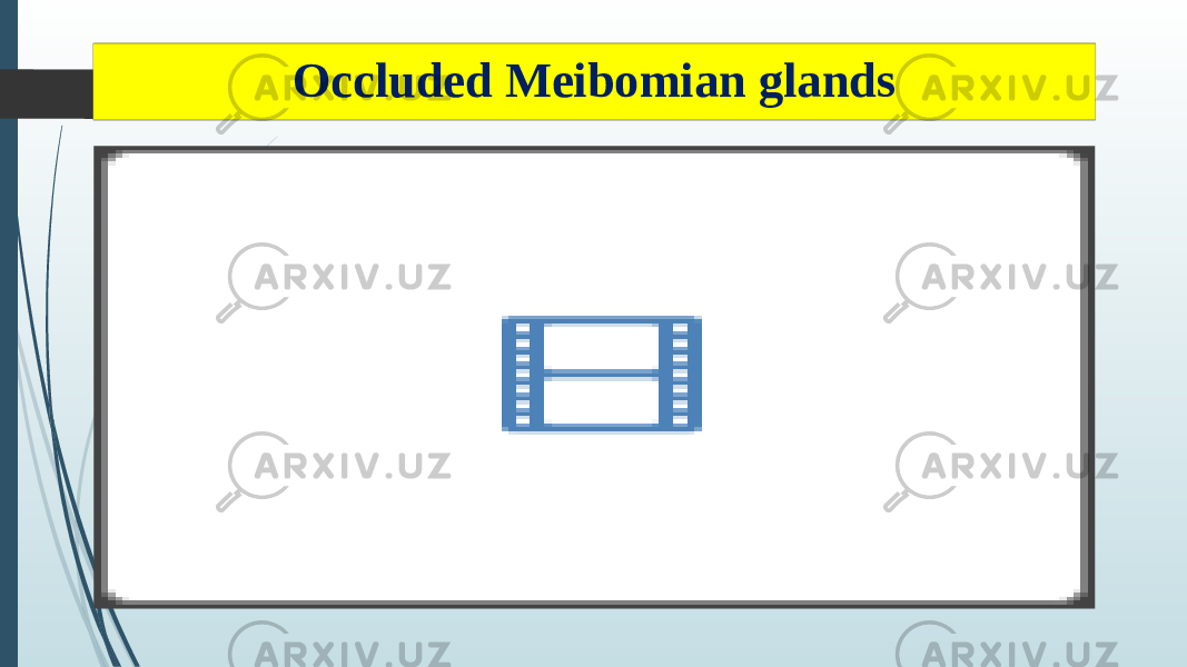 Occluded Meibomian glands 