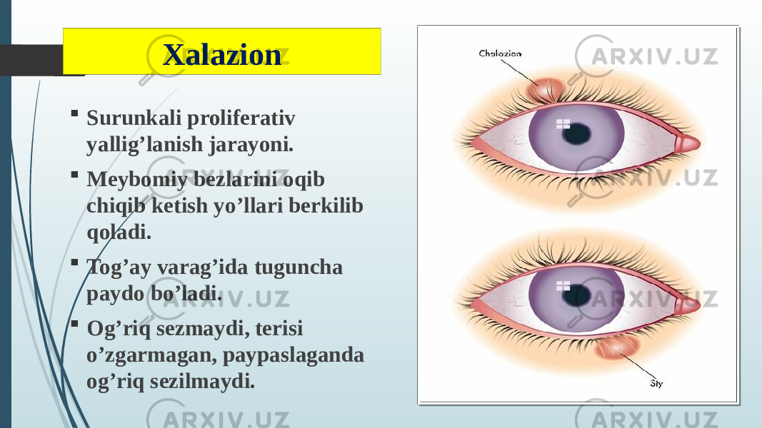 Xalazion  Surunkali proliferativ yallig’lanish jarayoni.  Meybomiy bezlarini oqib chiqib ketish yo’llari berkilib qoladi.  Tog’ay varag’ida tuguncha paydo bo’ladi.  Og’riq sezmaydi, terisi o’zgarmagan, paypaslaganda og’riq sezilmaydi. 