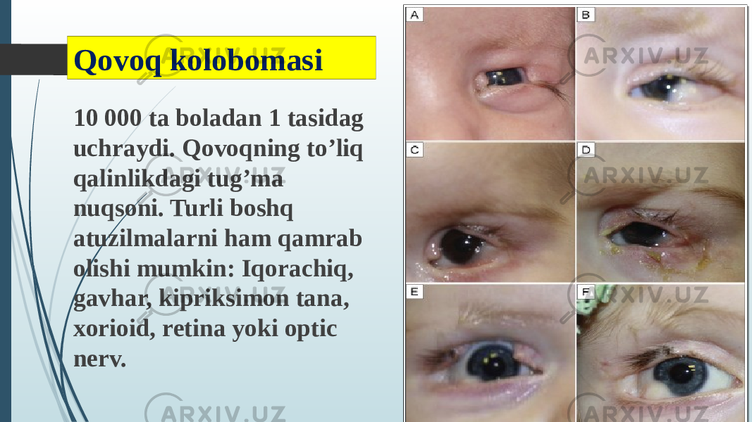 Qovoq kolobomasi 10 000 ta boladan 1 tasidag uchraydi. Qovoqning to’liq qalinlikdagi tug’ma nuqsoni. Turli boshq atuzilmalarni ham qamrab olishi mumkin: Iqorachiq, gavhar, kipriksimon tana, xorioid, retina yoki optic nerv. 