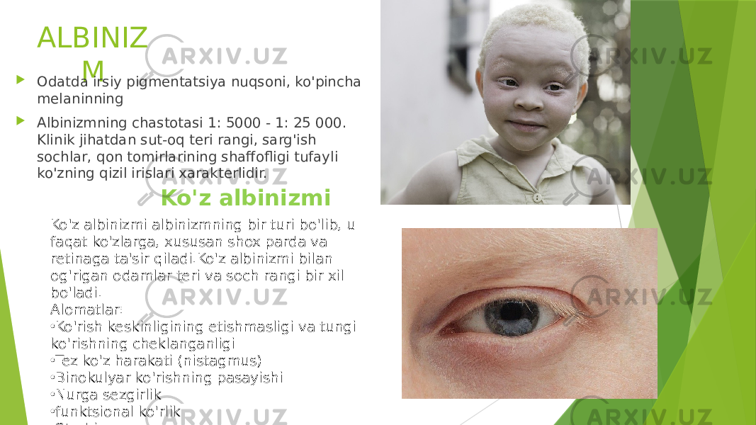 ALBINIZ M  Odatda irsiy pigmentatsiya nuqsoni, ko&#39;pincha melaninning  Albinizmning chastotasi 1: 5000 - 1: 25 000. Klinik jihatdan sut-oq teri rangi, sarg&#39;ish sochlar, qon tomirlarining shaffofligi tufayli ko&#39;zning qizil irislari xarakterlidir. Ko&#39;z albinizmi albinizmning bir turi bo&#39;lib, u faqat ko&#39;zlarga, xususan shox parda va retinaga ta&#39;sir qiladi.Ko&#39;z albinizmi bilan og&#39;rigan odamlar teri va soch rangi bir xil bo&#39;ladi. Alomatlar: • Ko&#39;rish keskinligining etishmasligi va tungi ko&#39;rishning cheklanganligi • Tez ko&#39;z harakati (nistagmus) • Binokulyar ko&#39;rishning pasayishi • Nurga sezgirlik • funktsional ko&#39;rlik • Strabismus Ko&#39;z albinizmi 