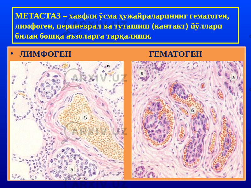 МЕТАСТАЗ – хавфли ўсма ҳужайраларининг гематоген, лимфоген, периневрал ва туташиш (кантакт) йўллари билан бошқа аъзоларга тарқалиши. • ЛИМФОГЕН ГЕМАТОГЕН 