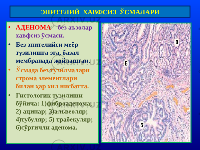 • АДЕНОМА – без аъзолар хавфсиз ўсмаси. • Без эпителийси меёр тузилишга эга, базал мембранада жойлашган. • Ўсмада без тузилмалари строма элементлари билан ҳар хил нисбатта. • Гистологик тузилиши бўйича: 1)фиброаденома; 2) ацинар; 3)альвеоляр; 4)тубуляр; 5) трабекуляр; 6)сўрғичли аденома. ЭПИТЕЛИЙ ХАВФСИЗ ЎСМАЛАРИ 