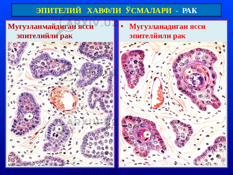 Мугузланмайдиган ясси эпителийли рак • Мугузланадиган ясси эпителйили ракЭПИТЕЛИЙ ХАВФЛИ ЎСМАЛАРИ - РАК 