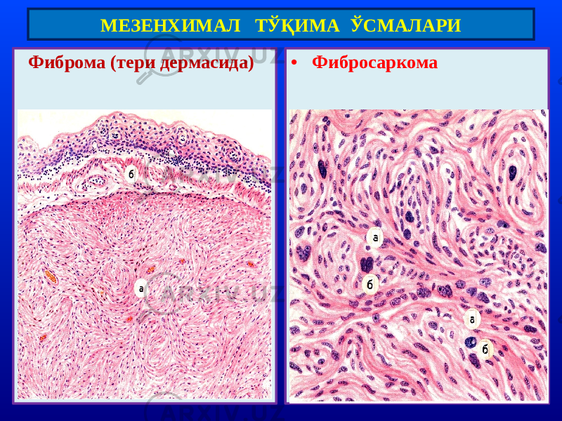  Фиброма (тери дермасида) • ФибросаркомаМЕЗЕНХИМАЛ ТЎҚИМА ЎСМАЛАРИ 