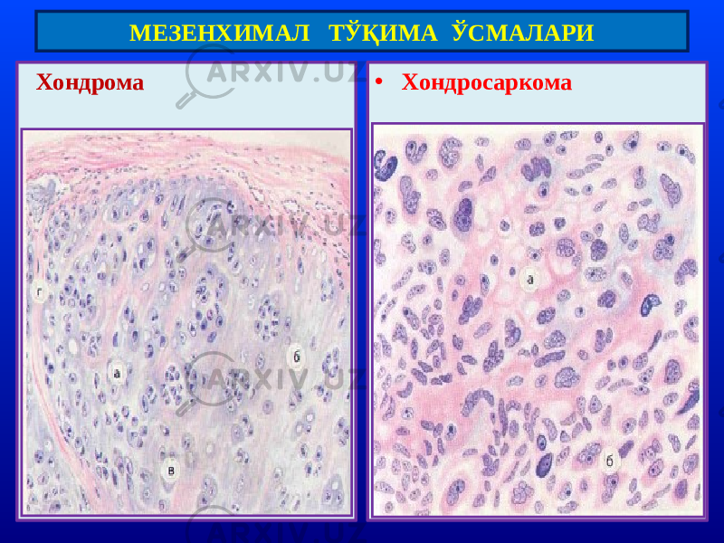  Хондрома • ХондросаркомаМЕЗЕНХИМАЛ ТЎҚИМА ЎСМАЛАРИ 