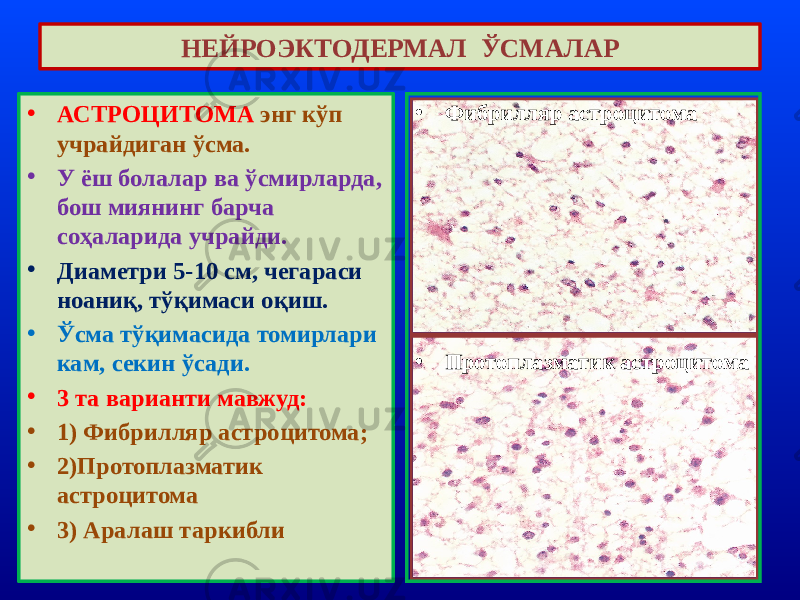 • АСТРОЦИТОМА энг кўп учрайдиган ўсма. • У ёш болалар ва ўсмирларда, бош миянинг барча соҳаларида учрайди. • Диаметри 5-10 см, чегараси ноаниқ, тўқимаси оқиш. • Ўсма тўқимасида томирлари кам, секин ўсади. • 3 та варианти мавжуд: • 1) Фибрилляр астроцитома; • 2)Протоплазматик астроцитома • 3) Аралаш таркибли НЕЙРОЭКТОДЕРМАЛ ЎСМАЛАР • Фибрилляр астроцитома • Протоплазматик астроцитома 