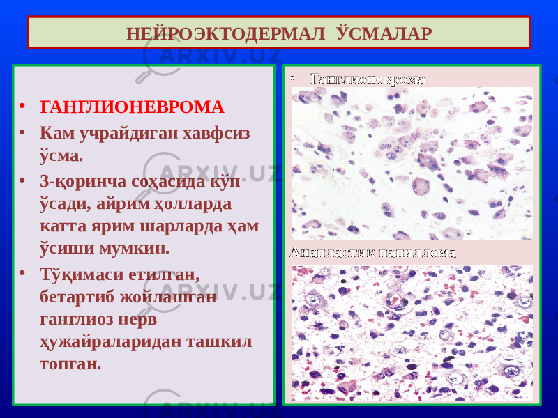 • ГАНГЛИОНЕВРОМА • Кам учрайдиган хавфсиз ўсма. • 3-қоринча соҳасида кўп ўсади, айрим ҳолларда катта ярим шарларда ҳам ўсиши мумкин. • Тўқимаси етилган, бетартиб жойлашган ганглиоз нерв ҳужайраларидан ташкил топган. НЕЙРОЭКТОДЕРМАЛ ЎСМАЛАР • Ганглионеврома Анапластик папиллома 