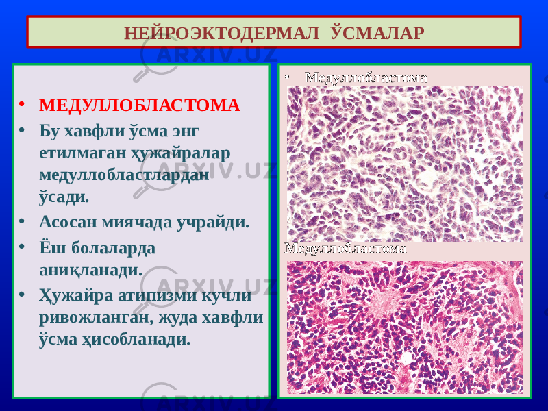 • МЕДУЛЛОБЛАСТОМА • Бу хавфли ўсма энг етилмаган ҳужайралар медуллобластлардан ўсади. • Асосан миячада учрайди. • Ёш болаларда аниқланади. • Ҳужайра атипизми кучли ривожланган, жуда хавфли ўсма ҳисобланади. НЕЙРОЭКТОДЕРМАЛ ЎСМАЛАР • Медуллобластома Медуллобластома 